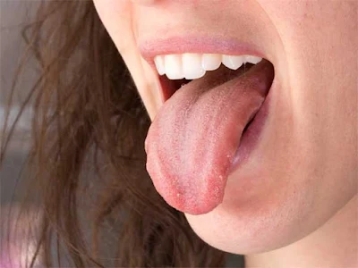 मुँह के छालों के लिए घरेलू उपचार