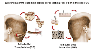 Diferencias de trasplante capilar FUE y FUT