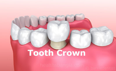 Tooth Crown