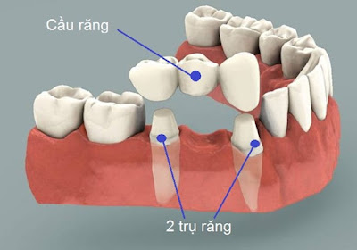 Chi phí trồng răng hàm bao nhiêu tiền?