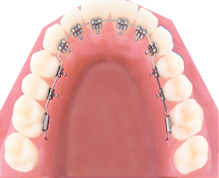Niềng răng mặt trong giúp điều chỉnh những sai lệch của răng như những mắc cài thông thường
