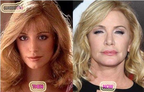 Shannon Tweed Plastic Surgery Before and After Photo