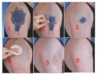 Laserless Tattoo Removal Guide Review — Does Natural Tattoo Removal Exist?