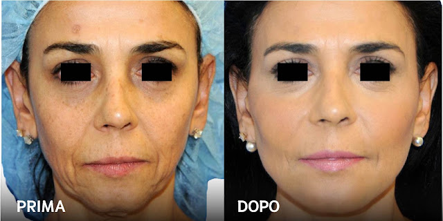 Lifting del viso e tratamento del viso di una donna di 63 anni, prima e dopo l'intervento, Tirana, ALbania