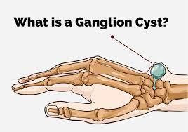 Ganglion Cyst