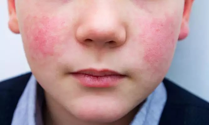 Παρβοϊός: Τι είναι και πώς κολλάει ο ιός που στοίχισε τη ζωή σε παιδί 3,5 ετών – Τα συμπτώματα και η αντιμετώπιση