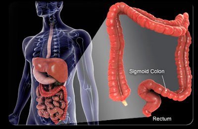 Colon Cancer Survival Rates by Stage.