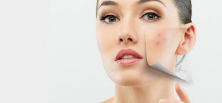 10 Simple Remedies For Treating Dry Skin Acne