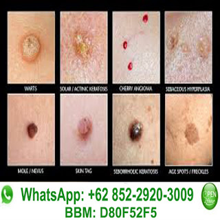 Obat Kutil Kelamin, TLP/LINE/WA: 085229203009, BBM: D80F52F5, Pengobatan Kutil Kelamin, Benjolan Bintik Bintil Daging Tumbuh Kutil Di Alat Kemaluan Kelamin, Obat Kutil Paling Ampuh, Obat Kutil, http://obat-kelamin.com/ Cara & Tips Menghilangkan Kutil Kelamin Paling Ampuh, Obat Kutil Kelamin Herbal, Obat Kutil Kelamin Tradisional, Obat Kutil Kelamin Alami, Obat Kutil Kelamin Pria Wanita (Penis, Vagina, Dubur Anus, Selangkangan Paha) Obat Kutil Kelamin Di Apotik Dokter, Obat Kutil Terbaik Terbukti Aman Tanpa Efek Samping Serta Terpercaya, Salep Krim Oles, 100% Terbukti, Terampuh Terbaik & Terpercaya, Ampuh, Manjur, Mujarab, Kumpulan obat kutil, pengobatan kutil kelamin, Pengobatan Kutil Kelamin Di Apotik/Dokter: miquimod podofilox podophyllin trichloroacetic acid bichloroacetic acid Condylox Fluorouracil interferon Krioterapi Elektrokauter Bedah Laser Operasi