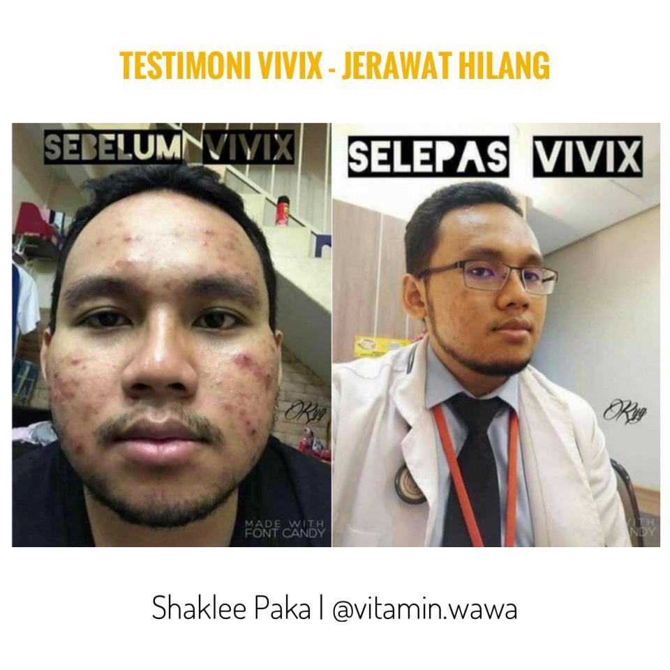 Vivix Shaklee testimoni, vivix Shaklee, vivix Shaklee untuk awet muda, vivix Shaklee untuk jerawat, vivix Shaklee untuk kulit, set awet muda shaklee  kesan awal vivix shaklee kepada kulit  testimoni vivix untuk kulit  cara makan set kecantikan shaklee  shaklee untuk kulit putih  testimoni shaklee  harga set kecantikan shaklee  set cantik Shaklee harga vivix Shaklee vivix shaklee tipu testimoni set kecantikan Shaklee vivix shaklee testimoni set jerawat Shaklee set jerawat shaklee untuk lelaki harga set jerawat Shaklee set jerawat shaklee budget