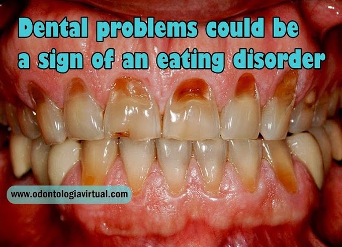 DENTAL NEWS: Dental problems could be a sign of an eating disorder