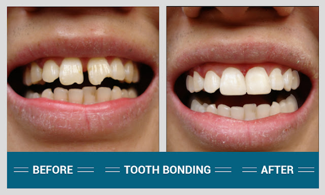 Tooth Bonding Procedures