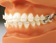 http://dentist-india-madurai.com/treatments-orthodontics-ceramic-braces.html