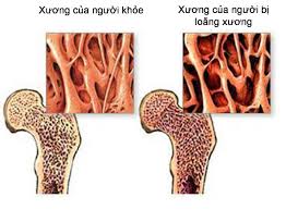 Bệnh loãng xương