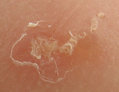 scabies on hands. Scabies Rash Pictures, Home