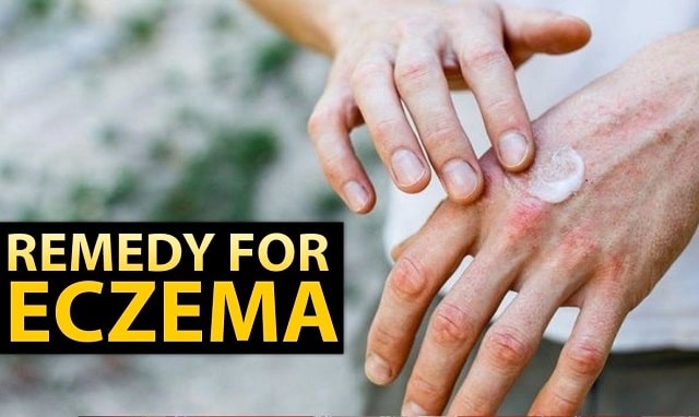 best home remedy for eczema natural treatment dry skin