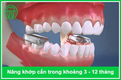 Nâng khớp cắn trong niềng răng có tác dụng gì? 1