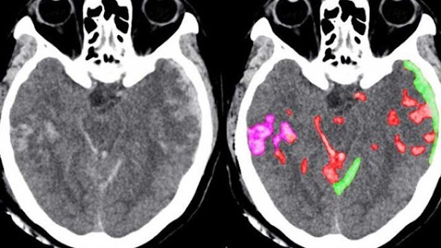 Algorithm turns out to be able to detect small bleeding in the brain