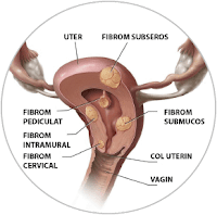 https://terapieinarmonie.blogspot.com/2019/09/fibromul-miomul-uterin.html