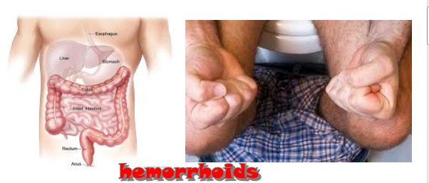 7 How to treat Hemorrhoids Naturally