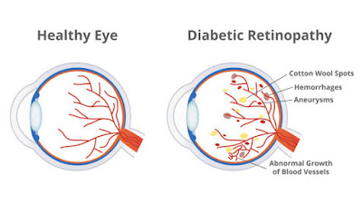 mengungkap-misteri-retinopati-diabetik-bahaya-dan-pencegahan