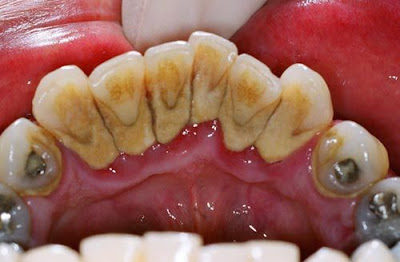 Cách điều trị chân răng bị đen như thế nào?