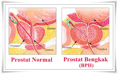 Cara Menyembuhkan Pembengkakan Kelenjar Prostat