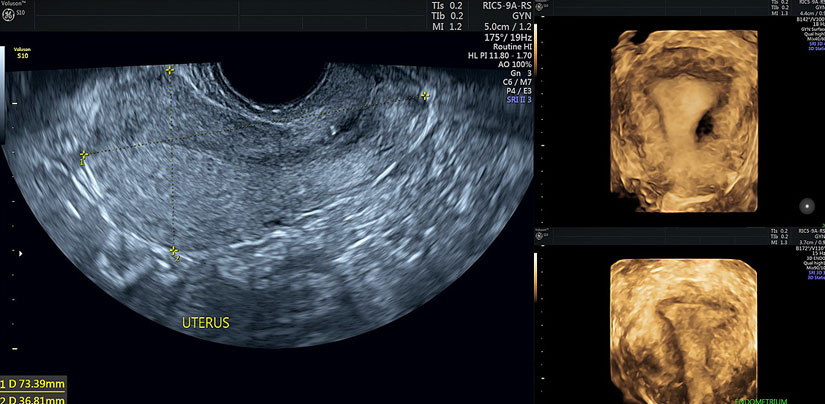 Trans-vaginal Gynaecology Ultrasound ( TVS )