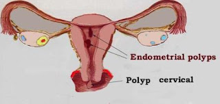 Penyebab polip rahim, gejala dan cara mengatasinya