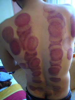 chinese fire cupping