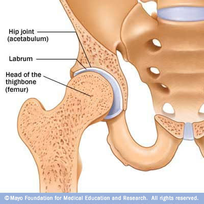 Hip Bone Cyst - a comprehensive view - Wellsphere
