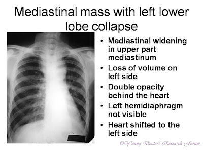 Mediastinal widening in upper part mediastinum Loss of volume on left side Double opacity behind the heart Left hemidiaphragm not visible Heart shifted to the left side