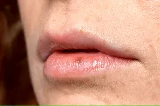 burn on delicate skin of lips being side effects of drinking hot water in empty Stomach