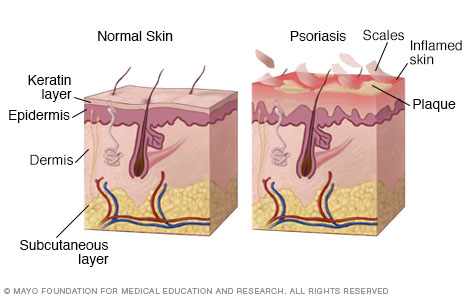 Psoriasis