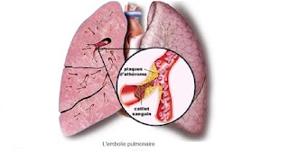 L'embolie pulmonaire ;Physiopathologie,symptômes,Pronostic et traitement