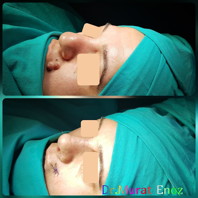 Crooked Nose Aesthetic, Nevus Excision From Lip,caudal septal dislocation, Nose Deformity,Complicated Nose Surgery