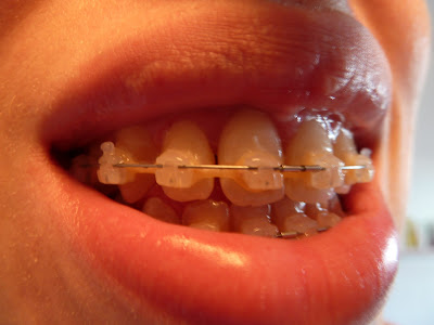 A photo of my teeth with the big new gaps almost closed