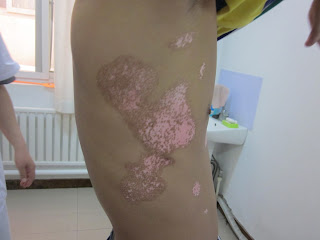Early Signs (symptoms) of Vitiligo