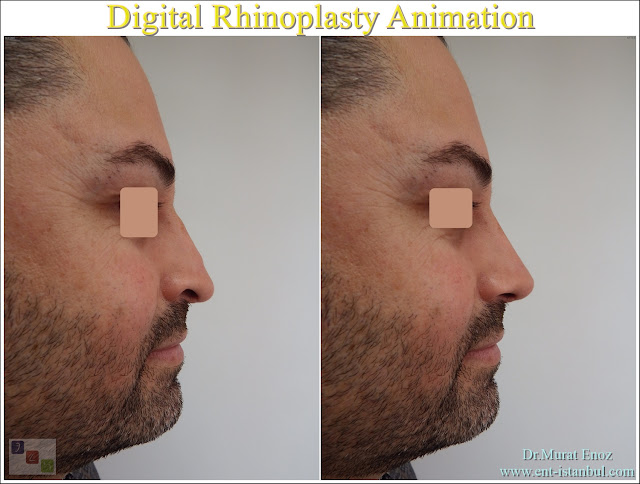 Rhinoplasty animation, Digital nose aesthetics animation, Virtual nose aesthetics, Nose aesthetic operation simulation, Digital nose imaging