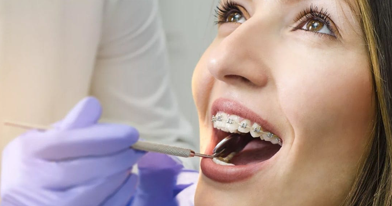 Ortodonti Tedavisi Hakkında Bilmeniz Gerekenler