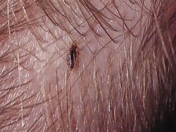 How To Get Rid of Head Lice