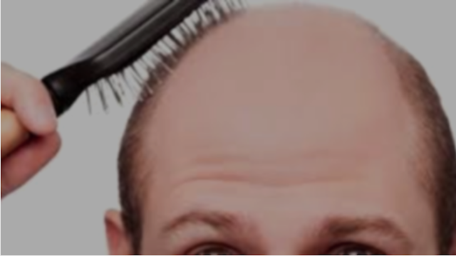 Causes of early baldness and solutions to prevent it.