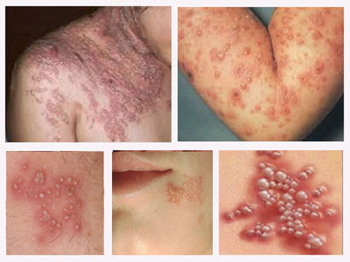 pengobatan herpes