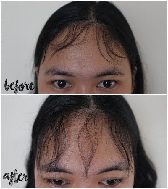 review hair treatment ERHA klinik