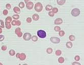 Immune Hemolytic Anemia
