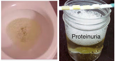 proteinuria