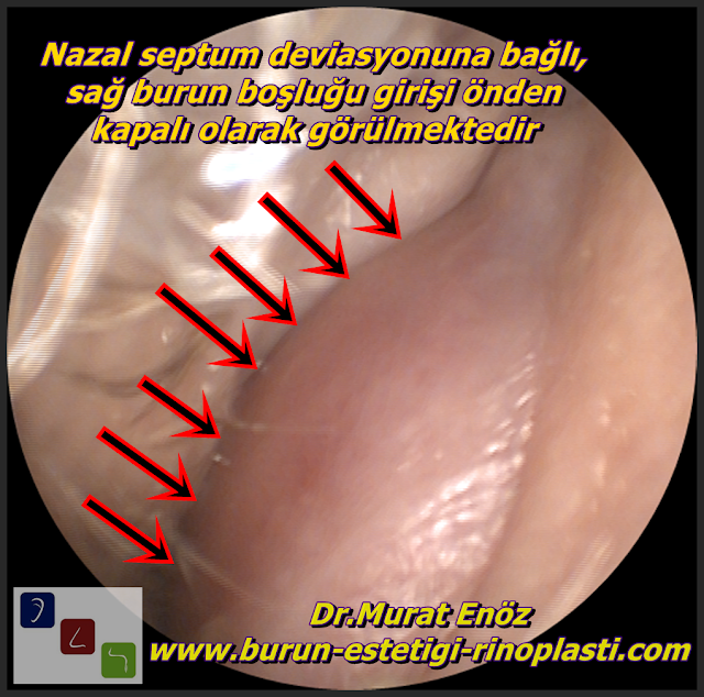 Burunda Nazal Septum Deviasyonu - Nazal Septum Deviasyonu Tanımı - Nazal Septum Deviasyonu Neden Olur? - Nazal Septum Deviasyonu Belirtileri - Nazal Septum Deviasyonu Yatış Pozisyonunu Etkileyebilir! - Burunda Kemik Spur Formasyonu - Nazal Septum Deviasyonu Türleri - Nazal Septum Deviasyonu Tanısı - Nazal Septum Deviasyonu Nasıl Anlaşılır? - Her Nazal Septum Deviasyonu Ameliyat Gerektirmez! - Nazal Septum Deviasyonu Tedavisi - Deviasyon Ameliyatı Nasıl Yapılır? - Deviasyon Ameliyatından Sonra Kıkırdak Eğriliği Tekrarlar mı? - Deviasyon Ameliyatının Riskleri - Deviasyon Ameliyatı Sonrasında Burun Ucu Düşmesi - Deviasyon Ameliyatı Sonrası Yapılması Gerekenler - Burun Kıkırdağı Eğriliği - Burunda Kemik Eğriliği - Nazal Septum Deviasyonu Çeşitleri