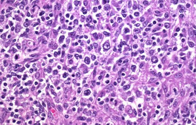 Diffuse large b cell lymphoma.