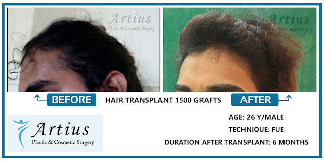 Hair transplant in Navi Mumbai