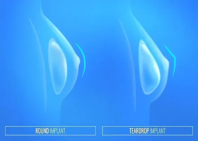mammoplasty